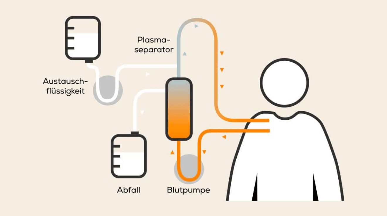 Abbildung: Plasmaaustausch